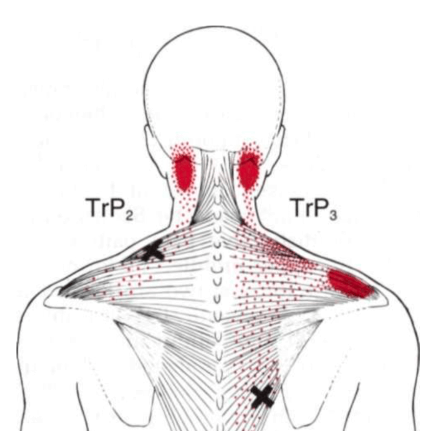 Pinched nerve trapezius How Do