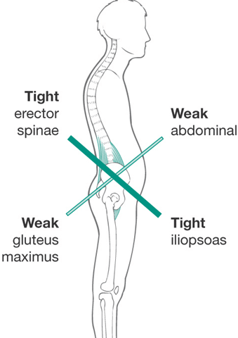 Lower Cross Syndrome