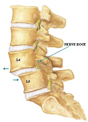 Lumbar Spinal Instability