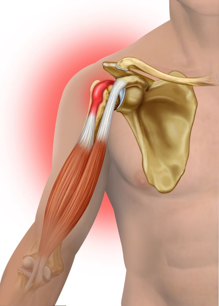 Biceps tendinopathy
