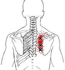 Upper and Middle Back injuries